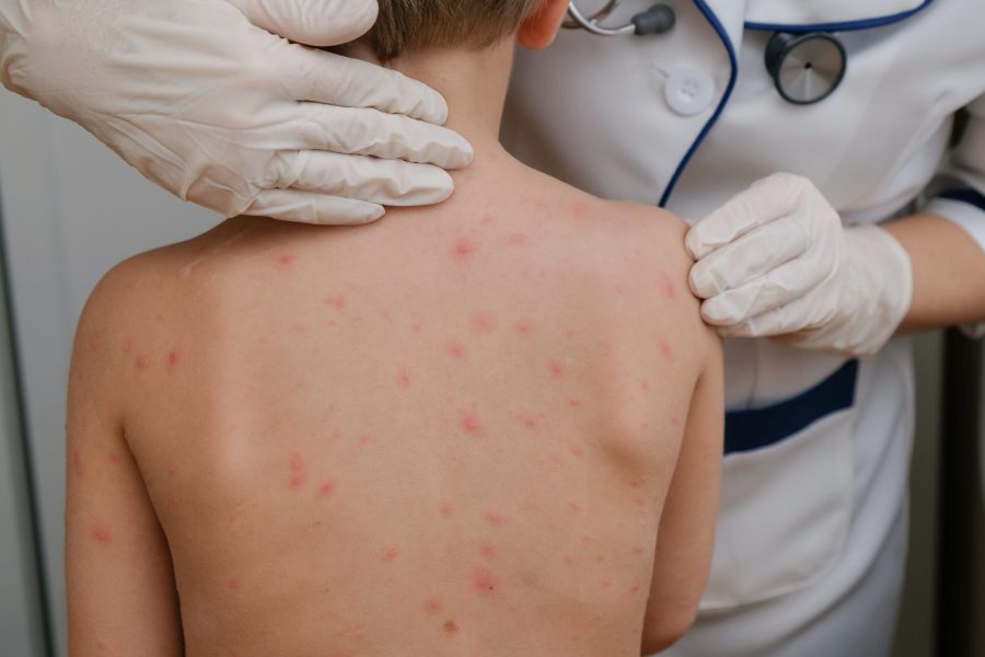 Close-up of naked body of child with pimples of chicken pox. pimples on the body of child with chickenpox